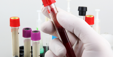 test tubes of blood drawn for a lab test