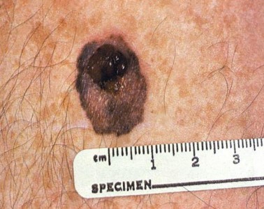 Superficial spreading malignant melanoma. Note the roughened edges of this mole, its heterogeneous, mottled, multicolored appearance, as well as its multi-textural composition, which are all characteristics that should evoke suspicions about its classification. An important feature here, is the single, large nodule, around which this pigmented patch arose, which is one of the characteristics of this form of melanoma.